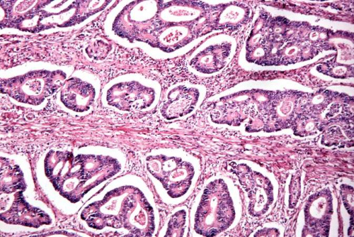 IPLab:Lab 7:Adenocarcinoma - Pathology Education Instructional Resource