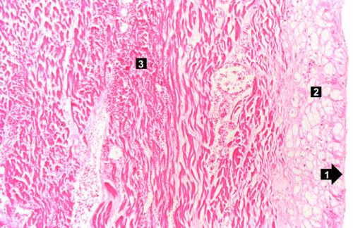 IPLab:Lab 1:Myocardial Infarction - Pathology Education Instructional ...