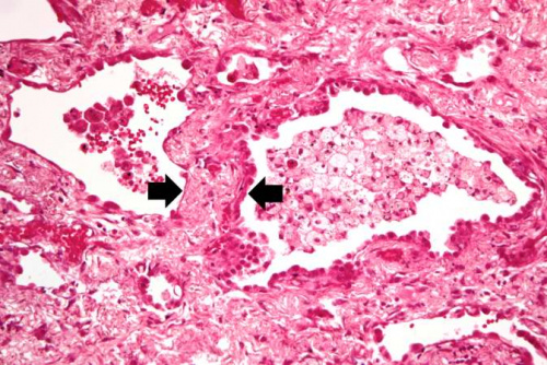 IPLab:Lab 12:Radiation Fibrosis - Pathology Education Instructional ...