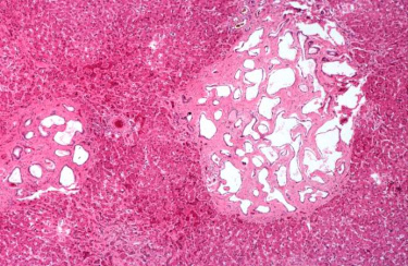 IPLab:Lab 5:Polycystic Kidney Disease - Pathology Education