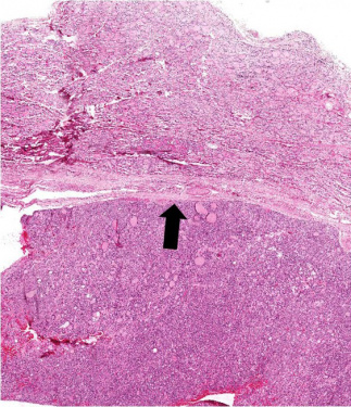 IPLab:Lab 7:Adenoma - Pathology Education Instructional Resource