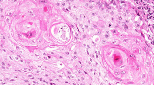 Iplab:lab 7:bronchogenic Carcinoma - Pathology Education Instructional 