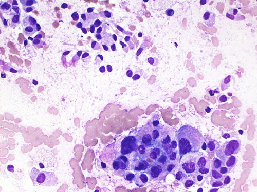 Cytologically Yours: Unknowns: 201310: Case 1 - Pathology Education ...