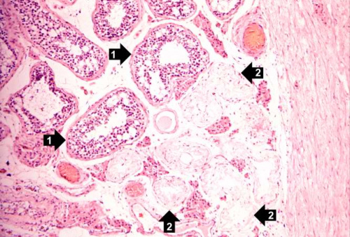 IPLab:Lab 2:Atrophy - Pathology Education Instructional Resource