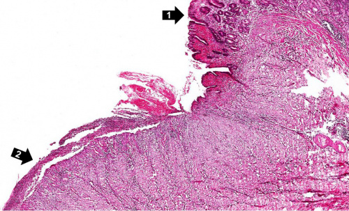 IPLab:Lab 3:Chronic Peptic Ulcer - Pathology Education Instructional ...