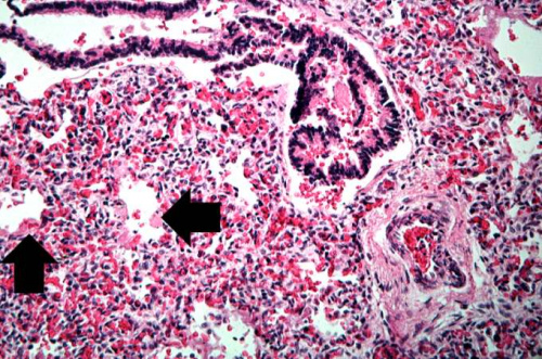 IPLab:Lab 13:Hyaline Membrane Disease - Pathology Education ...