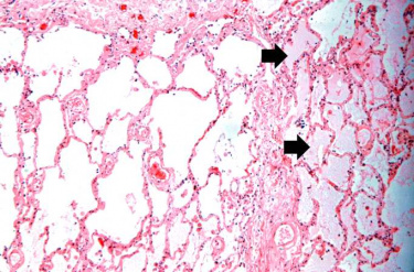 IPLab:Lab 4:Pulmonary Congestion and Edema - Pathology Education ...