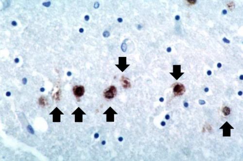 IPLab:Lab 8:HSV Encephalitis - Pathology Education Instructional Resource