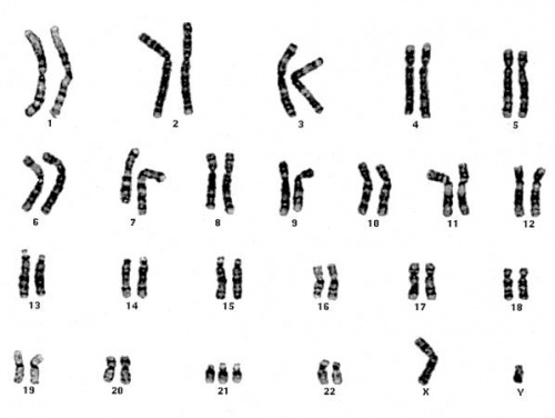 Iplab Lab 5 Trisomy 21 Pathology Education Instructional Resource