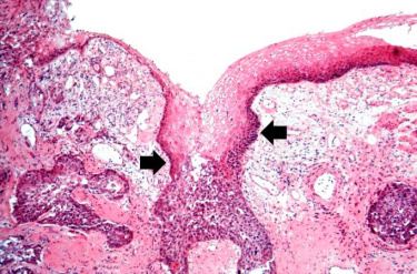 IPLab:Lab 7:Esophagus SCC - Pathology Education Instructional Resource