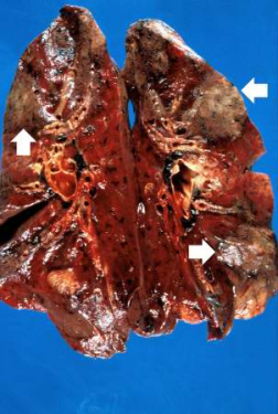 IPLab:Lab 12:Radiation Fibrosis - Pathology Education Instructional