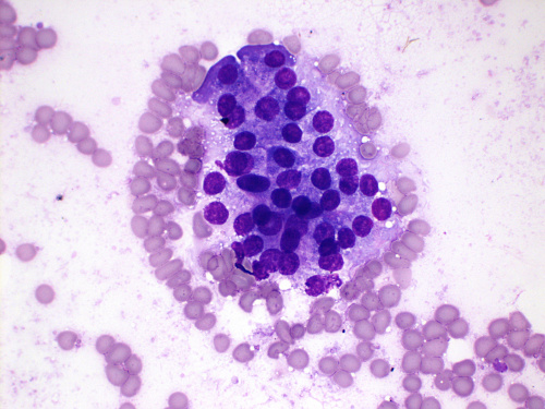 Cytologically Yours: Unknowns: 201401: Case 3 - Pathology Education ...