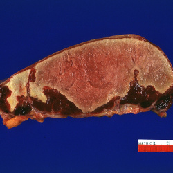Hematologic
