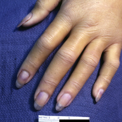 Extremities