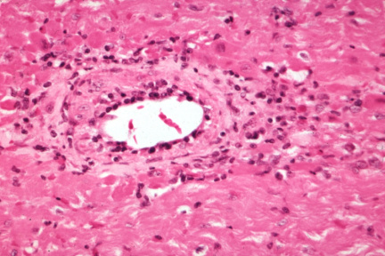 00001452