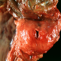 PEIR Pathology